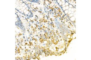 Immunohistochemistry of paraffin-embedded Human colon using FasLG antibody (ABIN3020741, ABIN3020742, ABIN3020743, ABIN1512897 and ABIN6213701) at dilution of 1:150 (40x lens).