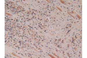 IHC-P analysis of Human Prostate Gland Cancer Tissue, with DAB staining. (Cytochrome C anticorps  (AA 5-100))