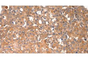 Immunohistochemistry of paraffin-embedded Human breast cancer tissue using BGLAP Polyclonal Antibody at dilution of 1:40 (Osteocalcin anticorps)