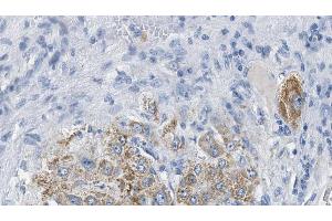 ABIN6274385 at 1/100 staining Human liver cancer tissue by IHC-P. (DOK7 anticorps  (C-Term))