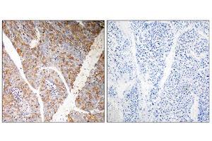 Immunohistochemistry analysis of paraffin-embedded human liver carcinoma tissue, using BAG3 antibody. (BAG3 anticorps  (Internal Region))