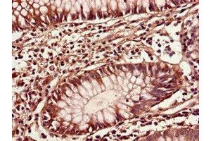 Immunohistochemistry of paraffin-embedded human colon cancer using ABIN7149396 at dilution of 1:100 (CIAO3 (AA 2-265) anticorps)