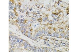 Immunohistochemistry of paraffin-embedded Human gastric cancer using NDUFS7 Polyclonal Antibody at dilution of 1:100 (40x lens).