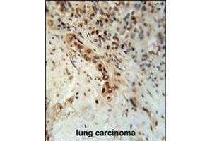 DCLRE1C Antibody (N-term) (ABIN653693 and ABIN2843013) immunohistochemistry analysis in formalin fixed and paraffin embedded human lung carcinoma followed by peroxidase conjugation of the secondary antibody and DAB staining. (DCLRE1C anticorps  (N-Term))