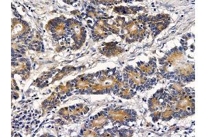 ABIN6257712 and ABIN6273523 at 1/100 staining human colorectal cancer by IHC-P. (IFRD1 anticorps  (N-Term))