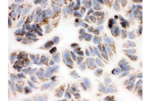 IHC analysis of Peroxiredoxin 3 using anti-Peroxiredoxin 3 antibody .