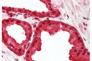 Rabbit Anti-MAT2A antibody Catalog Number: ARP46144 Formalin Fixed Paraffin Embedded Tissue: Human Prostate Primary antibody Concentration: 1:200 Secondary Antibody: Donkey anti-Rabbit-Cy3 Secondary Antibody Concentration: 1:200 Magnification: 20x Exposure Time: 0.