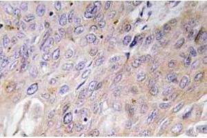 Immunohistochemistry (IHC) analyzes of BMP-3 antibody in paraffin-embedded human lung carcinoma tissue. (BMP3 anticorps)