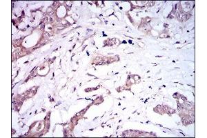 Immunohistochemical analysis of paraffin-embedded colon cancer tissues using BMPR1A mouse mAb with DAB staining.