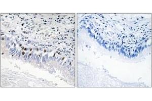 Immunohistochemistry analysis of paraffin-embedded human lung carcinoma, using MED12 Antibody. (MED12 anticorps  (AA 611-660))