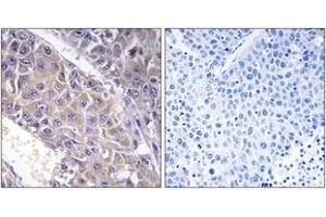 Immunohistochemistry analysis of paraffin-embedded human liver carcinoma tissue, using B4GALT3 Antibody. (B4GALT3 anticorps  (AA 271-320))