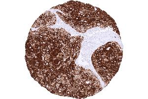 Squamous cell carcinoma of the skin with strong CK17 staining of all tumor cells (Recombinant KRT17 anticorps)