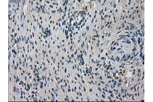 Immunohistochemical staining of paraffin-embedded Adenocarcinoma of breast tissue using anti-TMEM100 mouse monoclonal antibody. (TMEM100 anticorps)