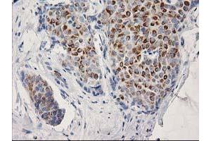 Immunohistochemical staining of paraffin-embedded Adenocarcinoma of Human breast tissue using anti-OSGEP mouse monoclonal antibody. (OSGEP anticorps  (AA 1-335))