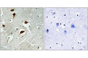 Immunohistochemistry analysis of paraffin-embedded human brain carcinoma, using 4E-BP1 (Phospho-Thr69) Antibody. (eIF4EBP1 anticorps  (pThr69))
