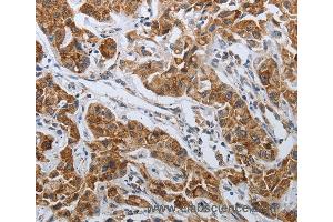 Immunohistochemistry of Human lung cancer using SPAG1 Polyclonal Antibody at dilution of 1:25 (SPAG1 anticorps)