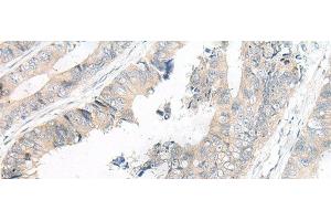 Immunohistochemistry of paraffin-embedded Human colorectal cancer tissue using FGF10 Polyclonal Antibody at dilution of 1:30(x200) (FGF10 anticorps)