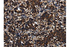 The image on the left is immunohistochemistry of paraffin-embedded Human liver cancer tissue using ABIN7191225(KLHL8 Antibody) at dilution 1/20, on the right is treated with synthetic peptide. (KLHL8 anticorps)