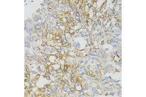 Immunohistochemistry of paraffin-embedded human prostate cancer using ND5 antibody (ABIN5975833) at dilution of 1/100 (40x lens). (MT-ND5 anticorps)