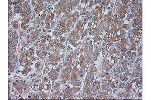 Immunohistochemical staining of paraffin-embedded Carcinoma of liver tissue using anti-TRPM4mouse monoclonal antibody. (TRPM4 anticorps)