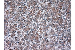 Immunohistochemical staining of paraffin-embedded Carcinoma of liver tissue using anti-TRPM4mouse monoclonal antibody.