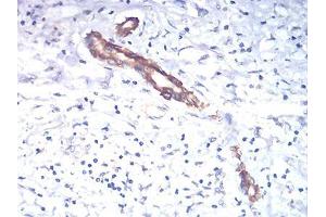 Immunohistochemical analysis of paraffin-embedded liver cancer tissues using TSHB mouse mAb with DAB staining. (TSHB anticorps  (AA 20-139))