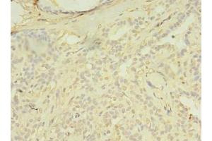 Immunohistochemistry of paraffin-embedded human breast cancer using ABIN7172654 at dilution of 1:100 (SPIC anticorps  (AA 1-248))