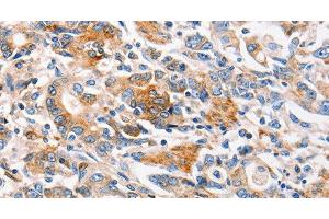 Immunohistochemistry of paraffin-embedded Human gasrtic cancer tissue using MC1R Polyclonal Antibody at dilution 1:100 (MC1 Receptor anticorps)