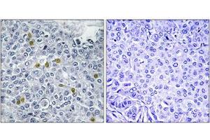 Immunohistochemical staining of paraffin-embedded human breast carcinoma tissue reacted with TOP2A (phospho S1106) polyclonal antibody  at 1:50-1:100 dilution. (Topoisomerase II alpha anticorps  (pSer1106))