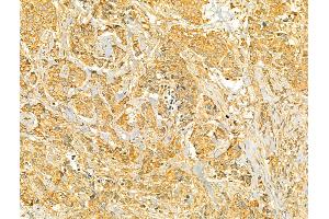 ABIN6265998 and ABIN6273087 at 1/100 staining Human breast cancer by IHC-P. (VPS37A anticorps  (N-Term))