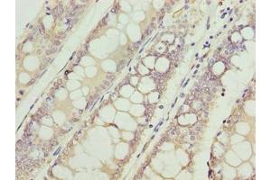 Immunohistochemistry of paraffin-embedded human colon cancer using ABIN7175315 at dilution of 1:100 (VPS45 anticorps  (AA 101-400))