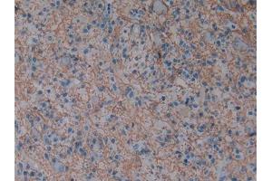 Detection of AQP1 in Human Glioma Tissue using Polyclonal Antibody to Aquaporin 1 (AQP1)