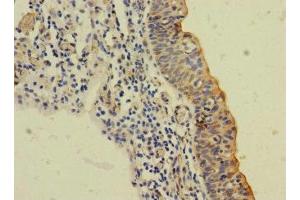 Immunohistochemistry of paraffin-embedded human bladder cancer using ABIN7169984 at dilution of 1:100 (SLC6A15 anticorps  (AA 357-452))