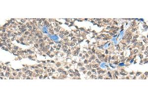 Immunohistochemistry of paraffin-embedded Human ovarian cancer tissue using REST Polyclonal Antibody at dilution of 1:50(x200) (REST anticorps)