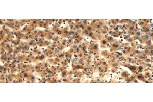 Immunohistochemistry of paraffin-embedded Human liver cancer tissue using TMOD1 Polyclonal Antibody at dilution of 1:60(x200) (Tropomodulin 1 anticorps)