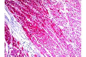 Formalin-fixed, paraffin-embedded human Melanoma stained with CD63 Mouse Monoclonal Antibody (NKI/C3) (AEC Chromogen)