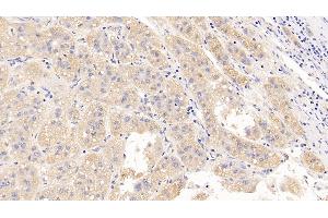 Detection of LH in Human Liver cancer Tissue using Polyclonal Antibody to Luteinizing Hormone (LH) (Luteinizing Hormone anticorps)