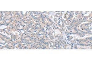 Immunohistochemistry of paraffin-embedded Human thyroid cancer tissue using SLC17A6 Polyclonal Antibody at dilution of 1:100(x200)