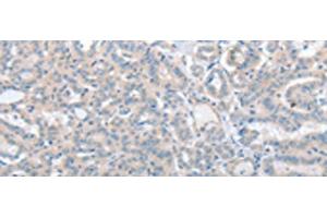 Immunohistochemistry of paraffin-embedded Human thyroid cancer tissue using SLC17A6 Polyclonal Antibody at dilution of 1:100(x200) (Solute Carrier Family 17 (Vesicular Glutamate Transporter), Member 6 (SLC17A6) anticorps)