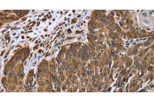 Immunohistochemistry of paraffin-embedded Human lung cancer tissue using PLXNB1 Polyclonal Antibody at dilution 1:40 (PLXNB1 anticorps)