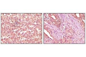 Immunohistochemical analysis of paraffin-embedded human skin carcinoma (left) and pancreas carcinoma (right) tissue, showing cytoplasmic localization using EphA2 antibody with DAB staining. (EPH Receptor A2 anticorps)