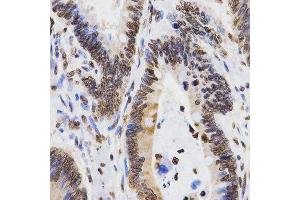 Immunohistochemistry of paraffin-embedded human rectal cancer using DiMethyl-Histone H3-K9 antibody.