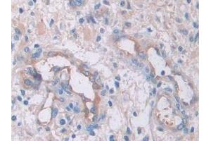 Detection of IL33 in Human Glioma Tissue using Monoclonal Antibody to Interleukin 33 (IL33)