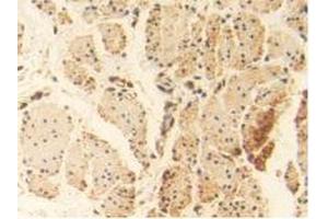 Detection of HSPA1A in Human Esophagus Cancer Tissue using Polyclonal Antibody to Heat Shock 70 kDa Protein 1A (HSPA1A)