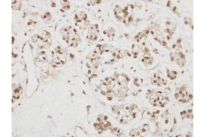 IHC-P Image Immunohistochemical analysis of paraffin-embedded OVCA xenograft, using NCBP1, antibody at 1:500 dilution.