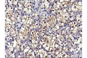 Immunohistochemical staining of paraffin-embedded Carcinoma of Human kidney tissue using anti-GSTO2 mouse monoclonal antibody.