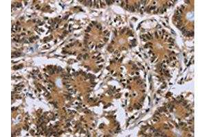 The image on the left is immunohistochemistry of paraffin-embedded Human colon cancer tissue using ABIN7191755(P2RY1 Antibody) at dilution 1/40, on the right is treated with synthetic peptide. (P2RY1 anticorps)