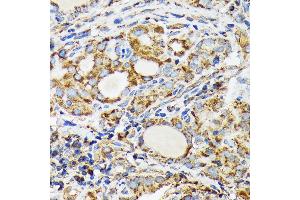 Immunohistochemistry of paraffin-embedded human thyroid cancer using NDUFS4 Rabbit mAb (ABIN7268821) at dilution of 1:100 (40x lens).