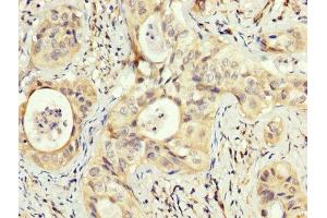 IHC image of ABIN7162986 diluted at 1:200 and staining in paraffin-embedded human cervical cancer performed on a Leica BondTM system.