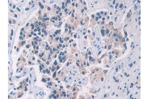 Detection of PFN2 in Human Prostate cancer Tissue using Polyclonal Antibody to Profilin 2 (PFN2)